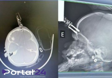 Menina de 1 ano sofre acidente doméstico com carregador cravado na testa em Divinópolis