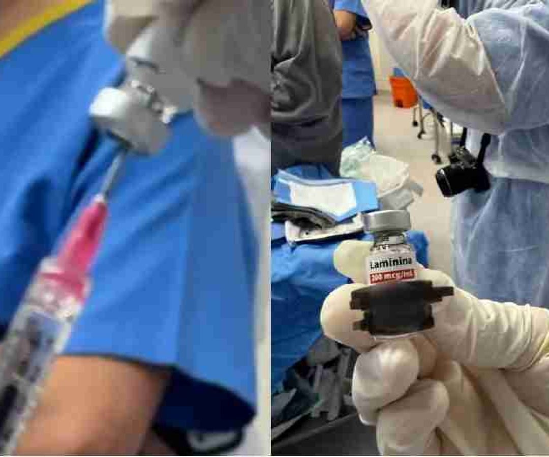 Cirurgia inédita com aplicação de polilaminina é realizada em hospital de Foz do Iguaçu - catve.com