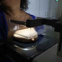 ANS defende que plano cubra mamografia digital sem restrição de idade