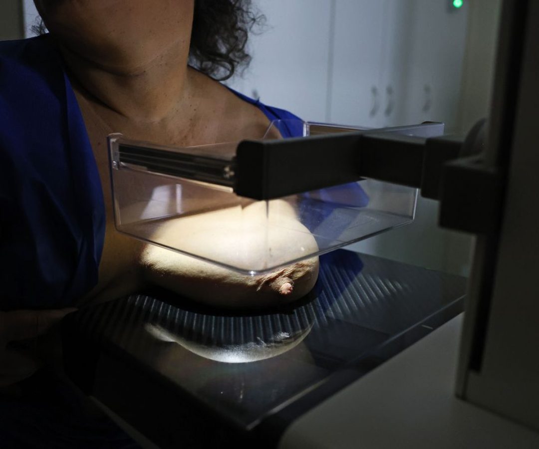 ANS defende que plano cubra mamografia digital sem restrição de idade