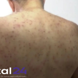 Aposentado sobrevive após ataque de enxame com mil picadas de abelha em Ponta Grossa