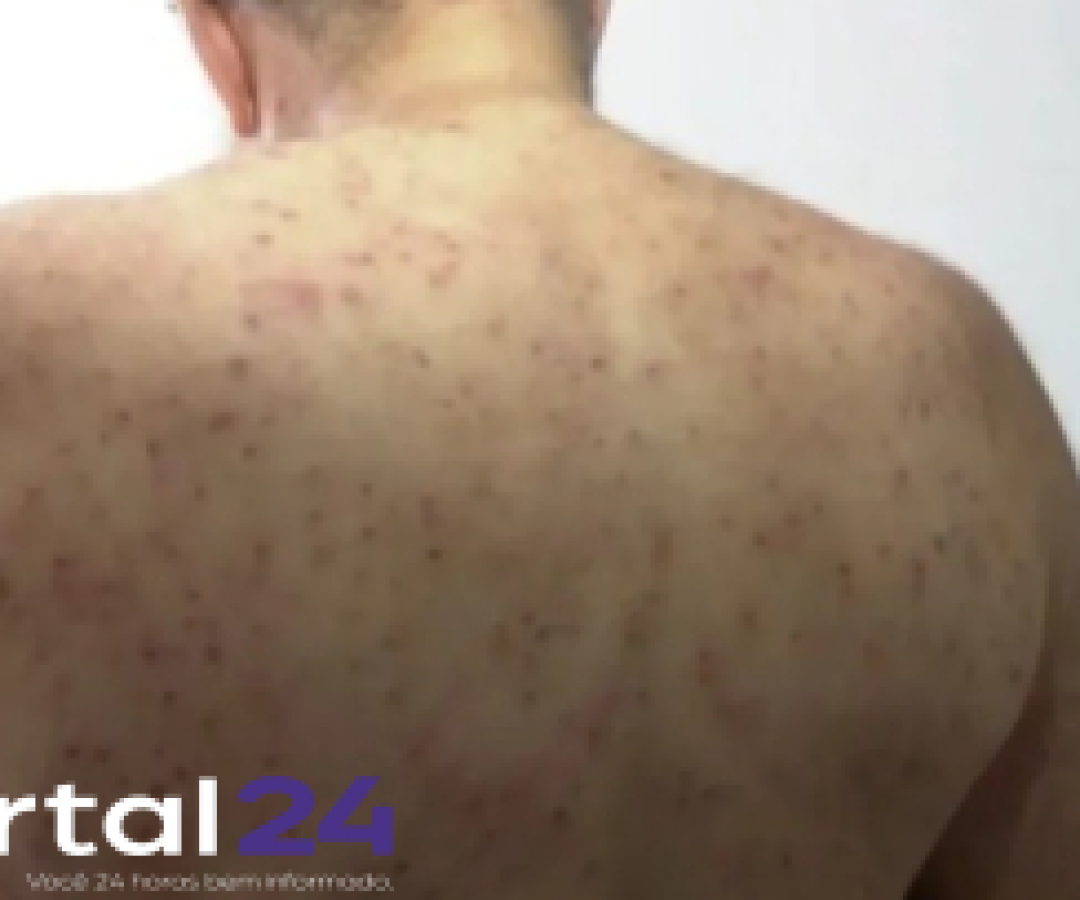 Aposentado sobrevive após ataque de enxame com mil picadas de abelha em Ponta Grossa