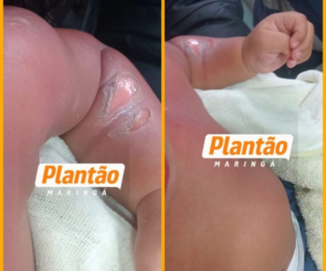Bebê de 8 meses fica ferido após incidente com chuveiro em CMEI de Sarandi