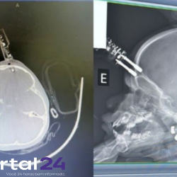 Menina de 1 ano sofre acidente doméstico com carregador cravado na testa em Divinópolis