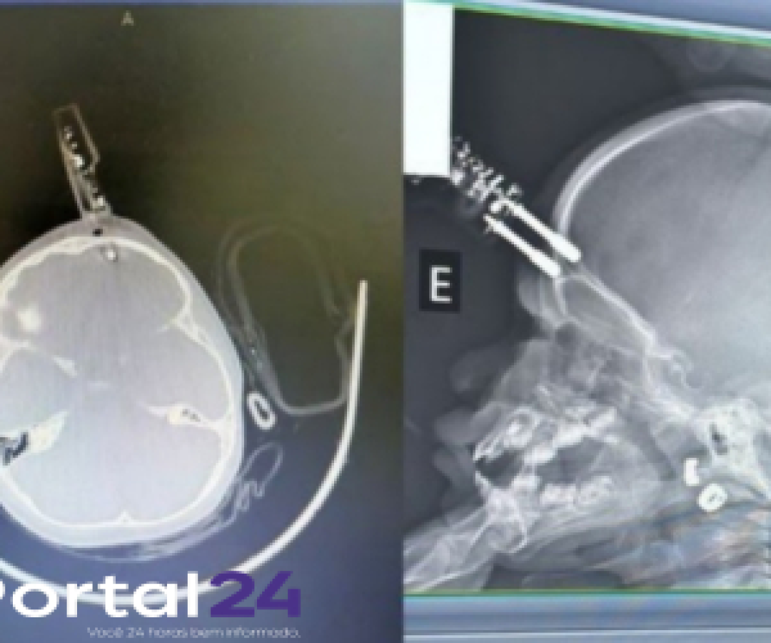 Menina de 1 ano sofre acidente doméstico com carregador cravado na testa em Divinópolis